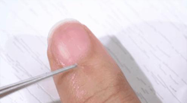 手上長倒刺是缺維生素？兩碼事兒！