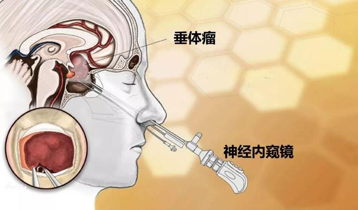 看不清東西 未必是眼睛的錯(cuò)