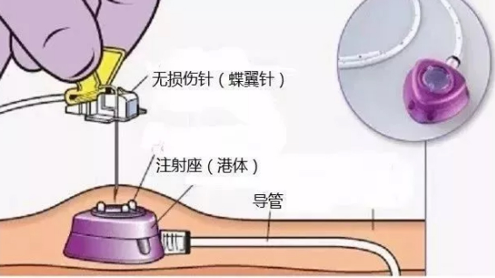 多學(xué)科協(xié)作破高齡治療難題，輸液港技術(shù)啟精準(zhǔn)醫(yī)療新篇--太原市第七人民醫(yī)院以創(chuàng)新實(shí)踐守護(hù)患者健康